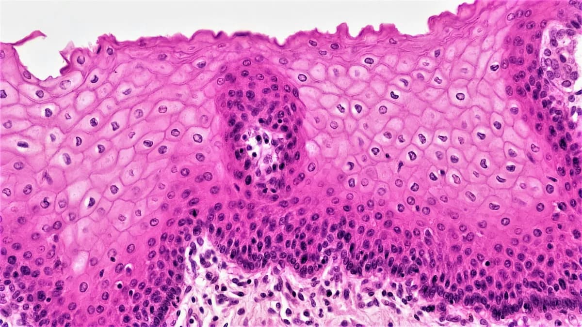Why Melanoma Spreads So Fast: The Hidden Story of BRAF, MAPK and Cellular Chaos